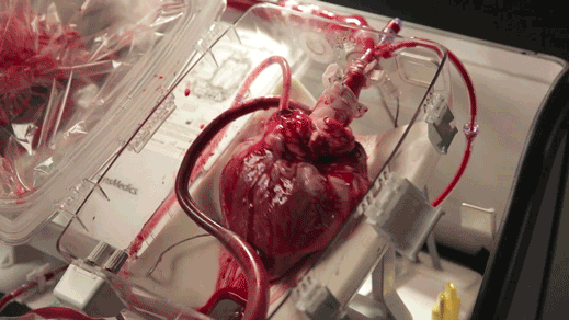 Heart_transplant_boxx519_0-1